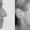 Rhinoplasty (Nose Job)