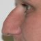 Rhinoplasty (Nose Job)