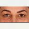 Eyelid surgery (Blepharoplasty)
