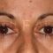 Lipofilling (grasso)
