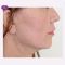Facelift - Lifestyle lift