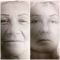 Facelift