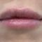 Lippenvergrößerung mit Hyaluronsäure