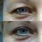 Eyelid surgery (Blepharoplasty)