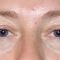 Korekcja powiek (Blepharoplastyka)