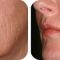 Fotorejuvenizácia /Resurfacing