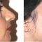 Rhinoplastie