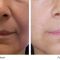 Facelift Silhouette Soft