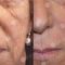 Filler antirughe a base di acido ialuronico