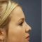 Rhinoplasty (Nose Job)
