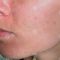 Acne laser, Cicatrici da acne laser