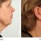Facelift - 3D kanylové nitě