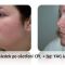 Radiofrekvenční rejuvenace - vyhlazení pleti (ShapeUp!, Aluma, Accent, TriPollar, Spa RF, Radiofrequency Re-Styling, Re-Age, Pellevé)