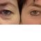 Eyelid surgery (Blepharoplasty)