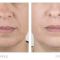 Botulinum toxin - Wrinkle Removal