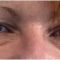 Operácia očných viečok (Blepharoplastika)