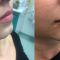 Hyaluronic acid-based wrinkle fillers