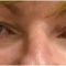 Operácia očných viečok (Blepharoplastika)