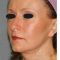 Facelift, SMAS Facelift