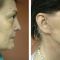 Facelift