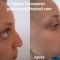 Rhinoplastie médicale