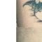 Rimozione tatuaggi - laser