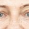 Operácia očných viečok (Blepharoplastika)