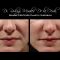 Hyaluronic acid-based wrinkle fillers