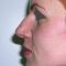 Rhinoplasty (Nose Job)