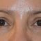 Eye Bags Treatment