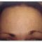 Nichtchirurgische Faltenbehandlung - BOTOX® / DYSPORT®