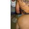 Rimozione tatuaggi - laser