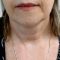 Neck lift