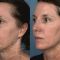 Face lift – Gold Threads
