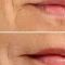 Filler