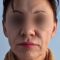 Facelift, SMAS facelifting