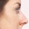 Operácia nosa (Rhinoplastika)