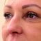 Eyelid surgery (Blepharoplasty)