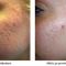 Radiofrekvenční rejuvenace - vyhlazení pleti (ShapeUp!, Aluma, Accent, TriPollar, Spa RF, Radiofrequency Re-Styling, Re-Age, Pellevé)