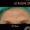 Lifting non chirurgico (Exilis)