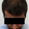 Haartransplantation
