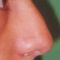 Cirugía de la nariz (Rinoplastia)