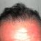 Trapianto capelli