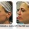 Radiofrekvenční rejuvenace - vyhlazení pleti (ShapeUp!, Aluma, Accent, TriPollar, Spa RF, Radiofrequency Re-Styling, Re-Age, Pellevé)