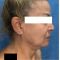 Lifting du visage