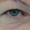 Operace očních víček (Blefaroplastika)