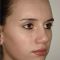 Rhinoplasty (Nose Job)