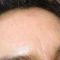 Mikrojehličkování, Microneedling (Skinroller - Dermaroller)