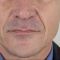 Teosyal, Restylane, Esthelis, Juverdem, Surgiderm (preparáty kyseliny hyaluronovej)