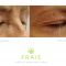 Operácia očných viečok (Blepharoplastika)